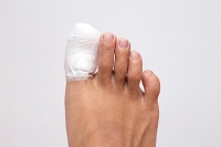 Diagnosing and Treating a Broken Toe
