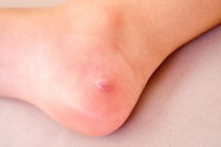 Causes and Contents of Foot Blisters