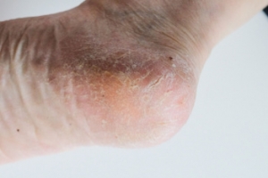 What Can Cause Cracked Heels?