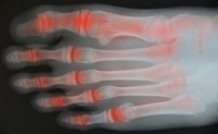 Assistive Devices for Foot or Ankle Arthritis