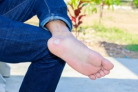 What to Know About Plantar Warts