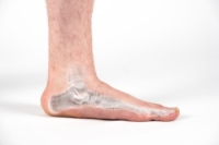 Exploring Surgical Options for Flat Feet