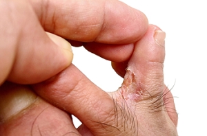 Athlete’s Foot Facts