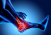 Foot Stress Fractures in Active Individuals