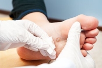 Foot Warts in Children