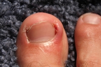Treatment for Infected Ingrown Toenails