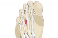 Morton’s Neuroma Is Treatable