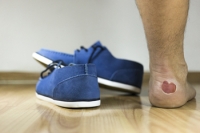 Common Causes of Foot Blisters