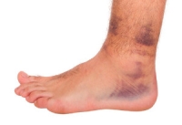 Causes and Symptoms of Broken Blood Vessels in Feet