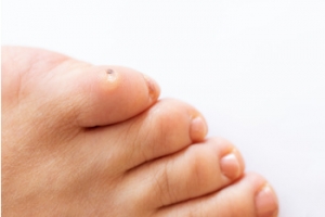 Caring for Corns on Children’s Feet