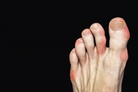 Foods That May Cause Gout