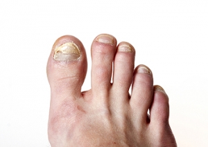Causes of Toenail Fungus