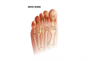 Recovering from Morton&#039;s Neuroma Surgery